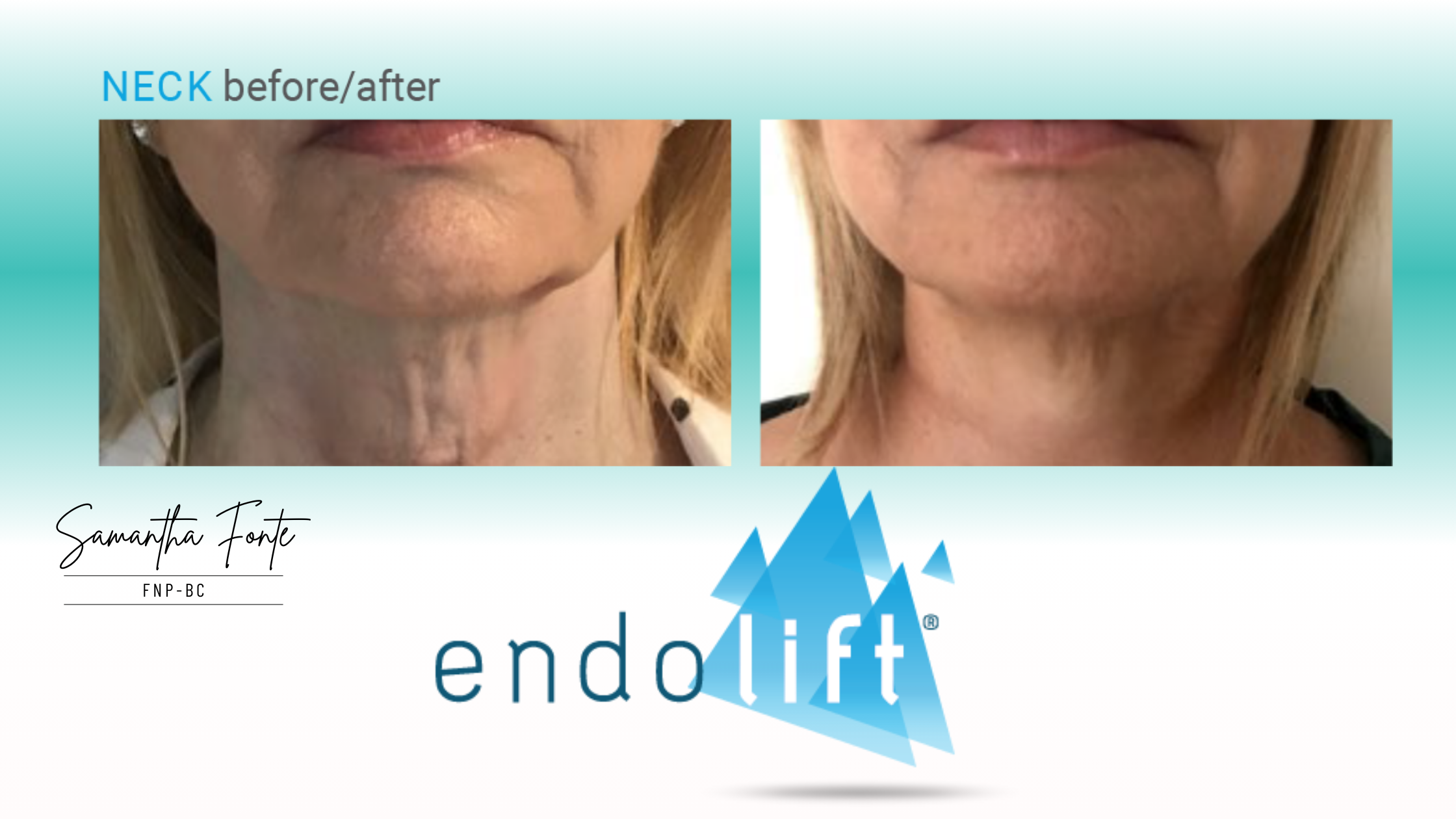 Endolift Turkey Neck Miami | Non-Surgical Neck Lift