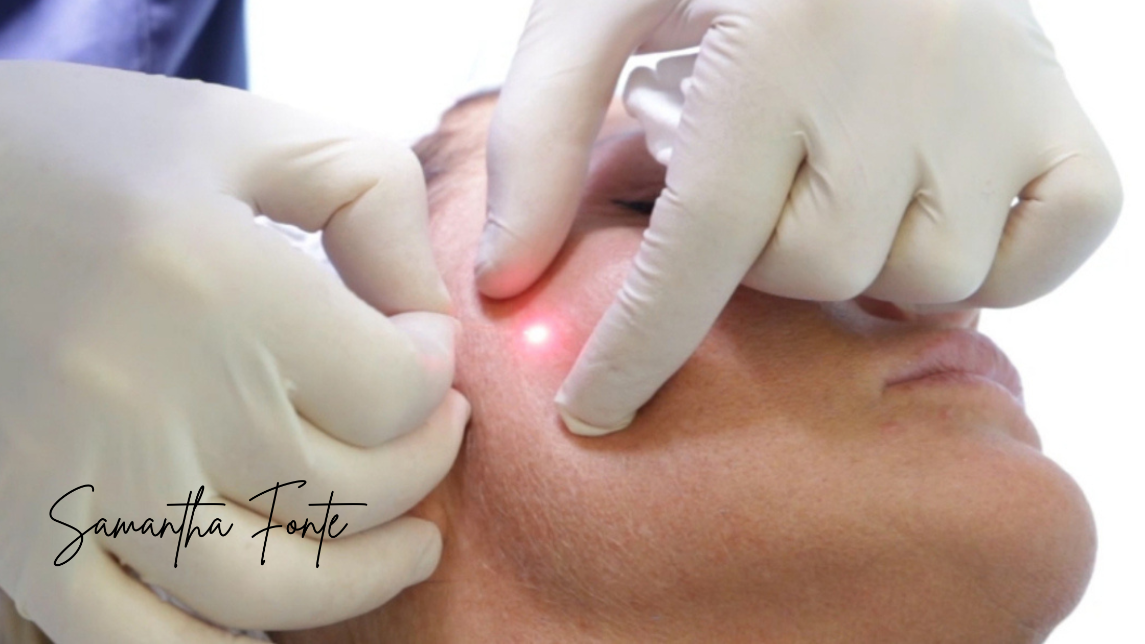Endolift in Miami for Jawline, Neck & Lower Face