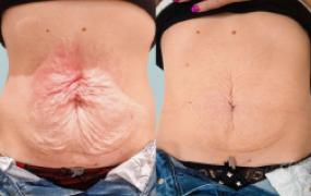 Tummy Skin Tightening