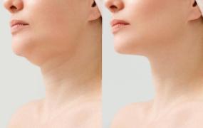 Under Chin Reduction Endolift