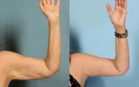 Under Arm Endolift