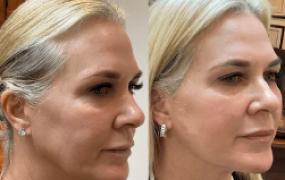 Lower Mid Face Endolift