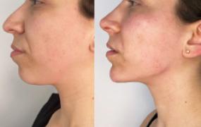 Mandibular Contour (Endolift)