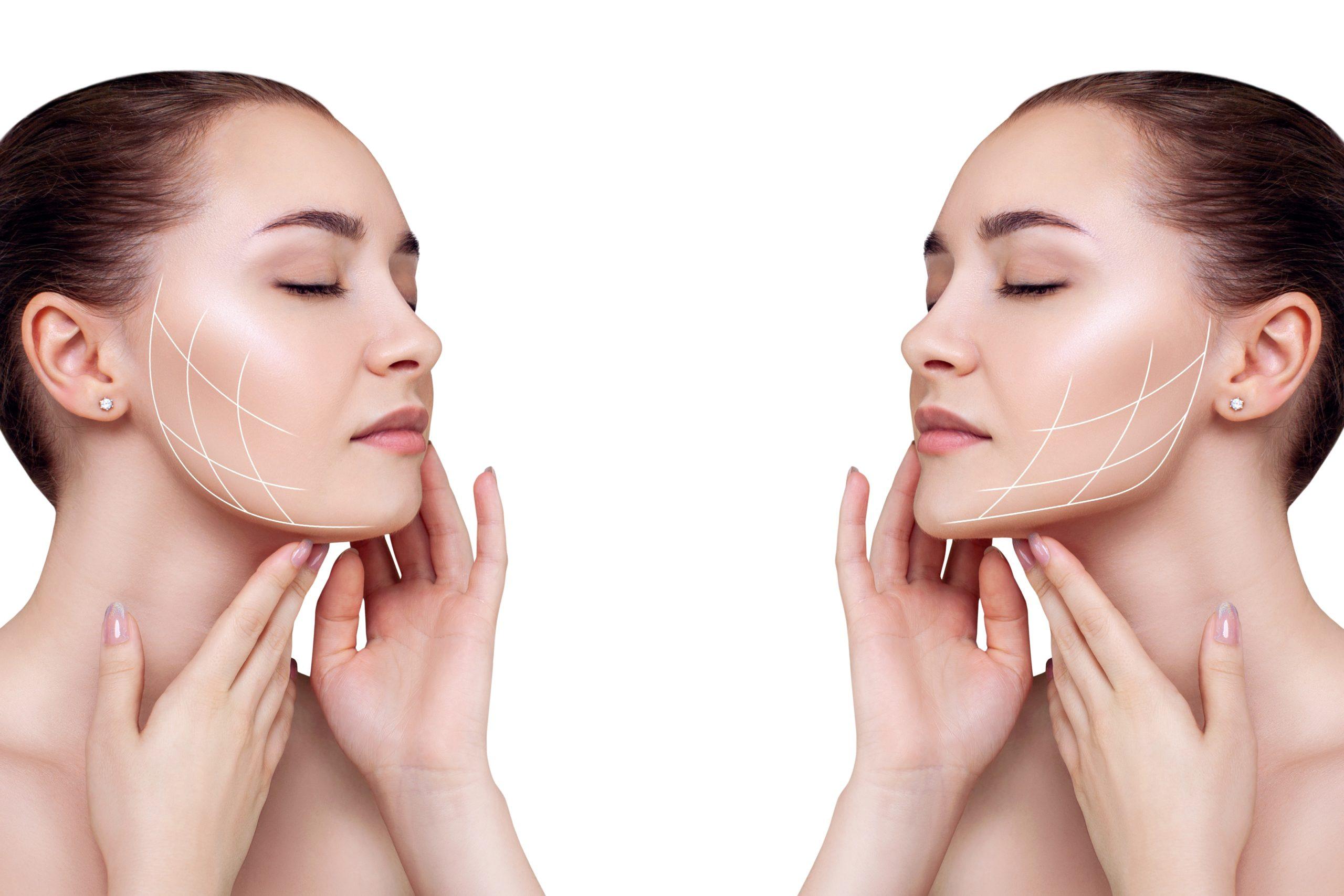 NECK LIFT AND TIGHTENING