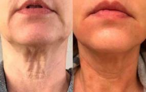 Neck Endolift