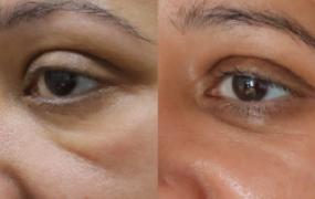 Lower Eyelid Endolift