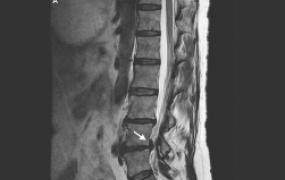 Lumbar Spine Scan
