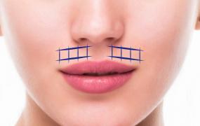 mini-cheek-lift
