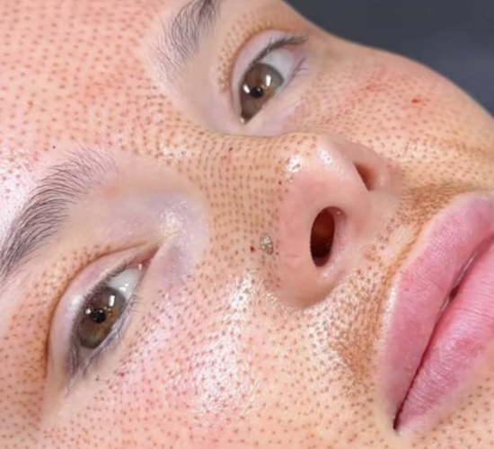 Fibroblast Skin Tightening Services | Plasma Fibroblast Therapy